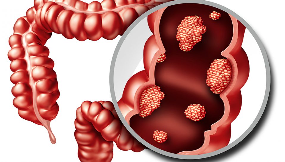 Fight Colorectal Cancer