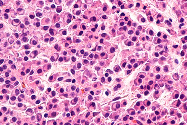 Multiple Myeloma