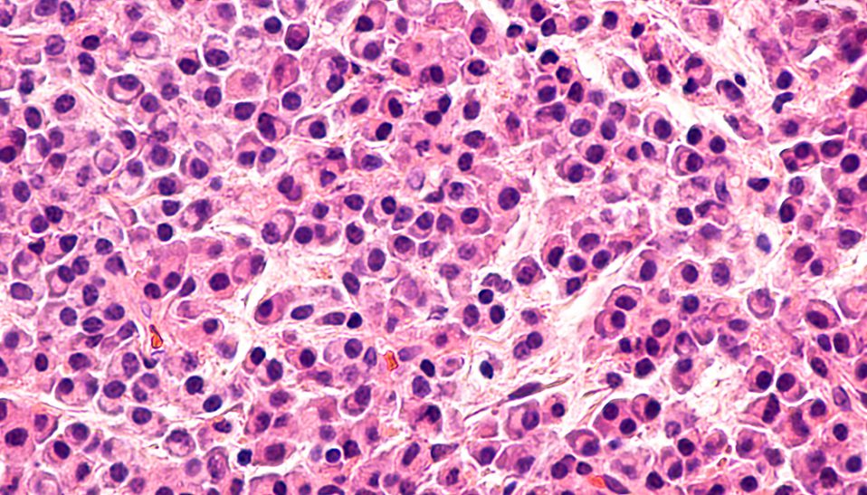 Multiple Myeloma