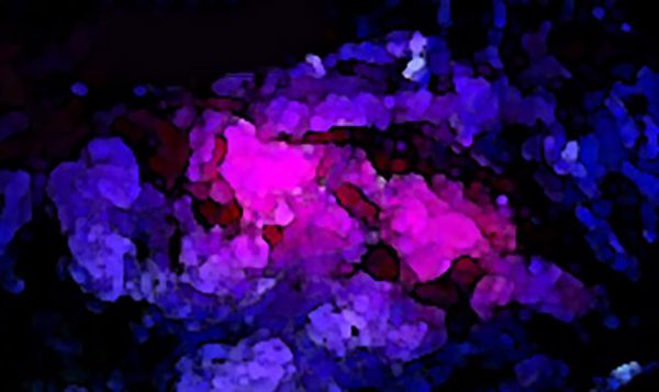 Pink Drink effect on Brain Tumor Treatment