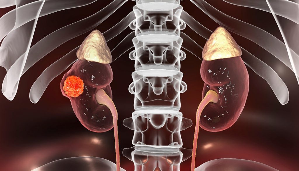 kidney cancer