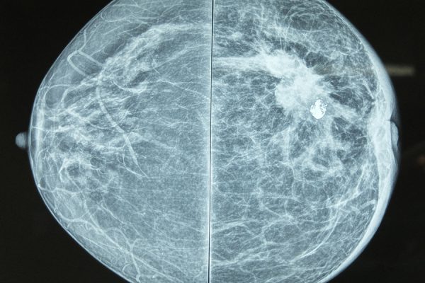 Mammogram