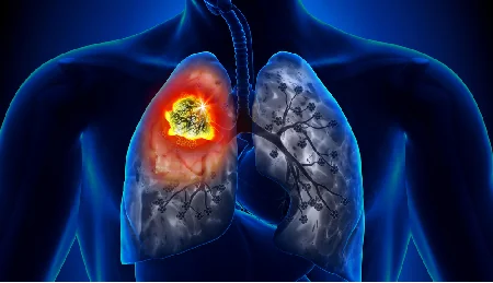 lung-cancer-feature-image