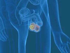 Testicular Cancer Location