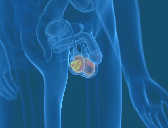 Testicular Cancer Location