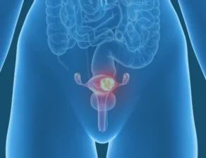 Uterine Cancer Location