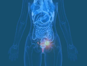 Ovarian Cancer Location