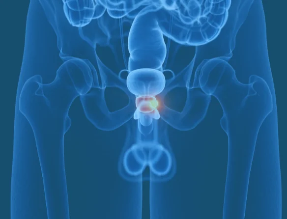 Prostate Cancer Location