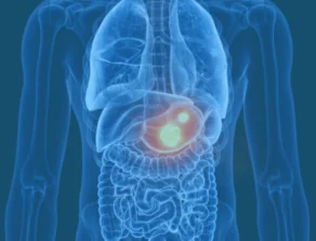Stomach Cancer Location Stomach Cancer Location