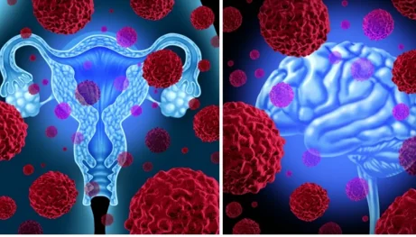 Brain-cancer-ovarian-cancer