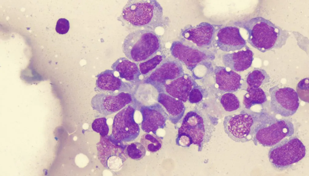 Rare-Disease-Day-Sarcoma Sarcoma: rare disease day