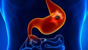 stomach cancer