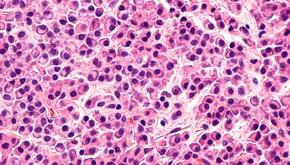 Multiple Myeloma