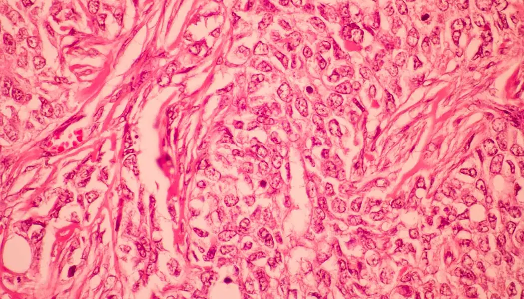 breast-cancer-metastasis breast cancer metastasis