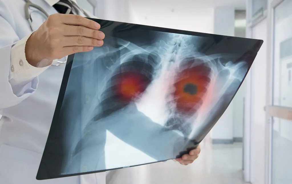 New discoveries this Lung Cancer Awareness Month Doctor examines a chest x-ray