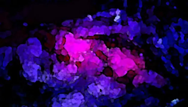 Pink Drink effect on Brain Tumor Treatment