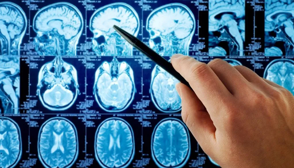 Alternative Brain Cancer Treatments Being Developed in the Labs Brain Cancer Treatment alternatives
