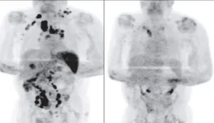 lymphoma covid in post Lymphoma Scan post COVID-19