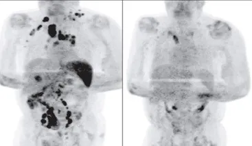Lymphoma Scan post COVID-19