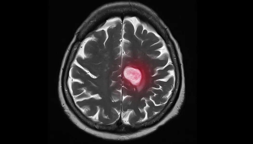 An,Axial,Cut,Magnetic,Resonance,Image,Or,Mri,Of,Brain metastasis breast cancer brain cancer